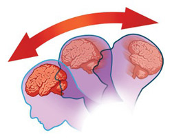 Image of the action that can cause a concussion