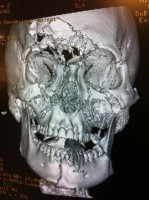 CT scan of patient's face before reconstructive surgery
