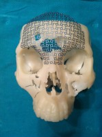 Forehead repair; titanium mesh is bone friendly