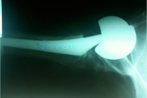 Metal-on-metal implant Metal-on-metal implant